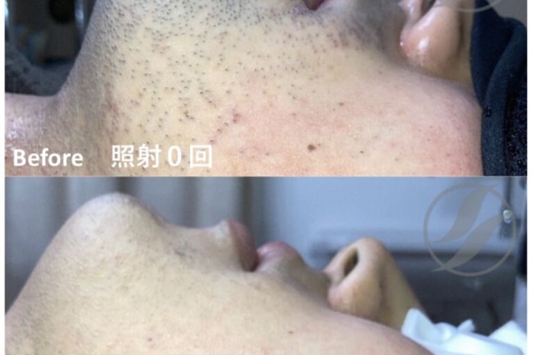 脱毛：ヒゲ